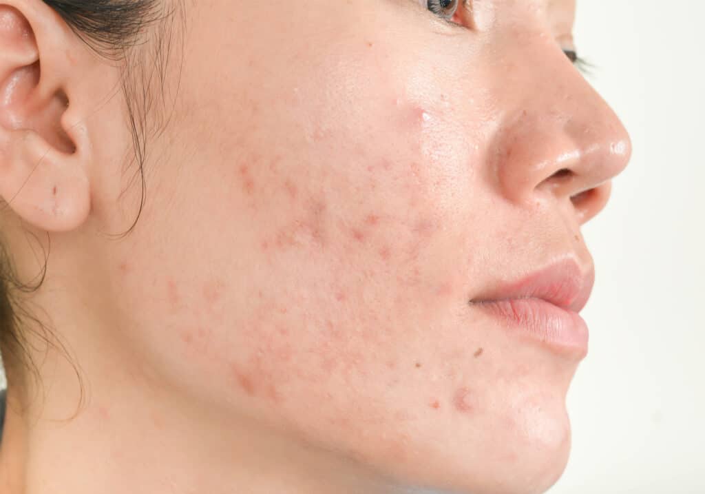 consecuencias del acné