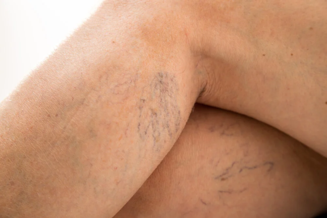 Venason: The Best Treatment to Take Care of Your Veins